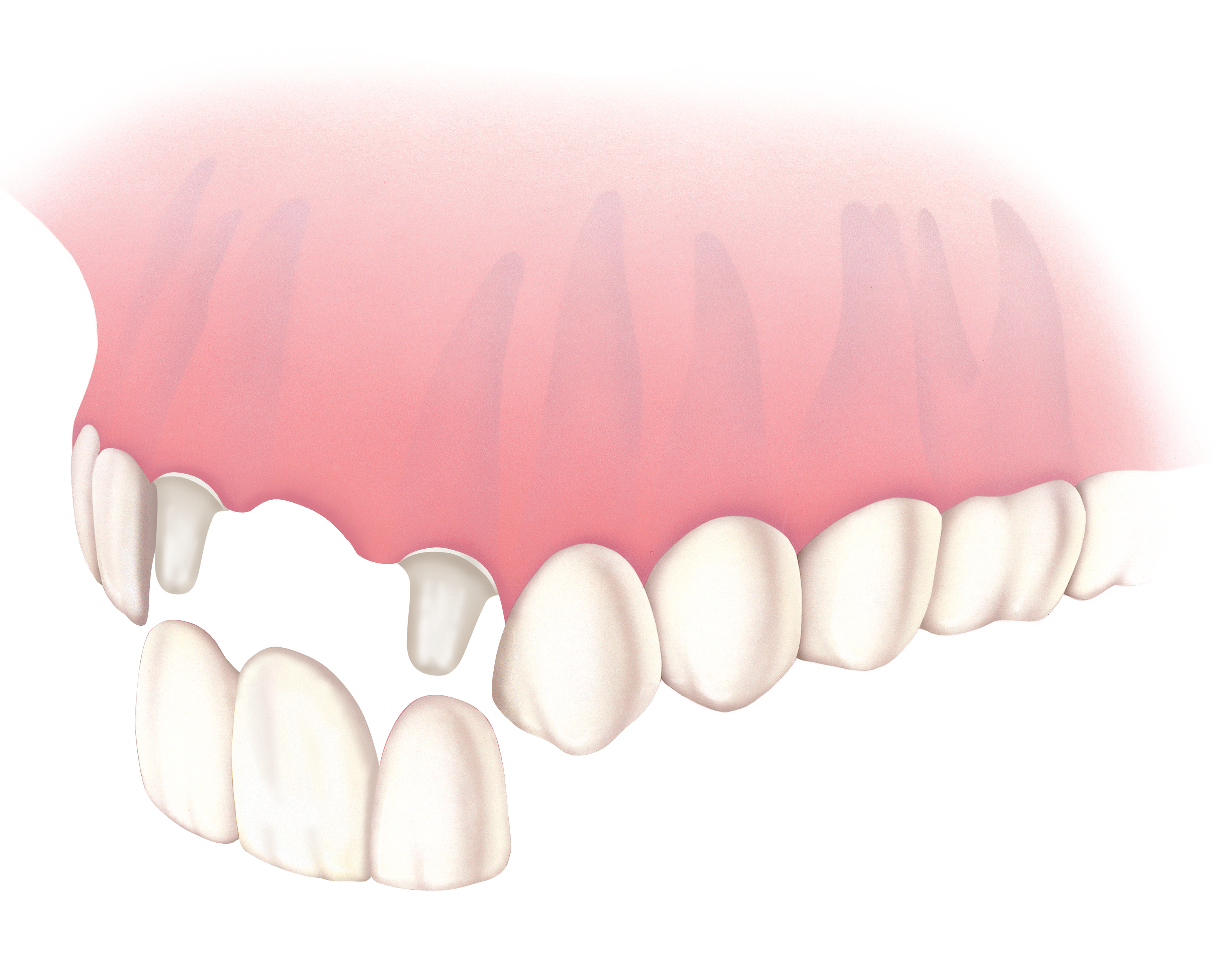 ブリッジ治療のデメリット